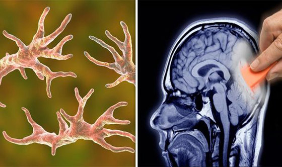 كائن مميت يتسلل إلى دماغ فتاة أثناء السباحة ويفتك بها في 7 أيام! صور صورة رقم 11
