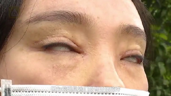 عملية تجميل.. تحرمها من إغلاق عينيها صورة رقم 1