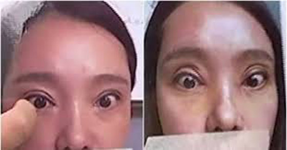 عملية تجميل.. تحرمها من إغلاق عينيها صورة رقم 3
