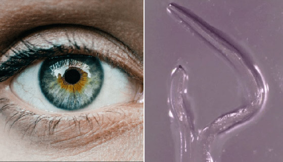 ظاهرة مخيفة.. امرأة تكتشف ديدان طفيلية في عينها وتخرجهم بنفسها! صورة رقم 4
