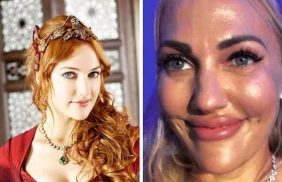 صور صادمة: للنجمات التركيات قبل وبعد عمليات التجميل صورة رقم 6