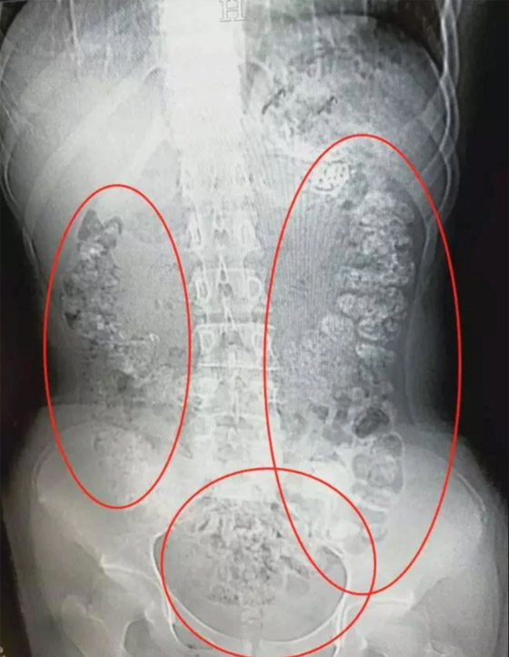 مراهقة تدخل في غيبوبة بعد شربها نوعا من الشاي يوميا لمدة شهر! صورة رقم 3