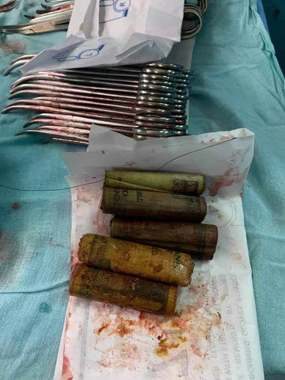 أطباء يستخرجون 6500 جنيه من معدة مواطن مصري! صور صورة رقم 3