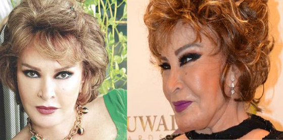 هكذا شوّهت عمليات التجميل هؤلاء المشاهير.. بينهم عرب (صور) صورة رقم 5