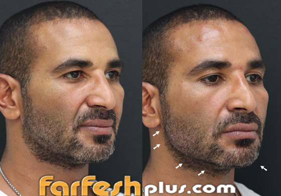 ريم البارودي تسخر من طليقها أحمد سعد وعملية التجميل التي أجراها بعد خطوبته صورة رقم 3