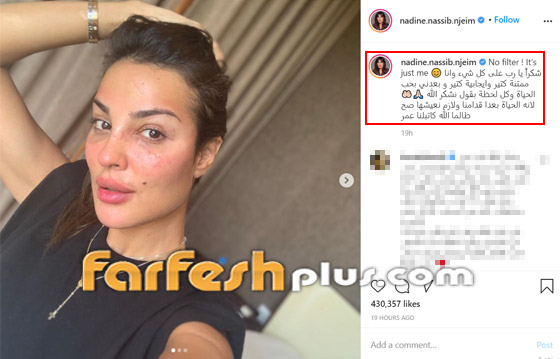 نادين نسيب نجيم تستعرض ندوبها بدون فلتر.. وهذا موعد ظهورها على التلفاز صورة رقم 1