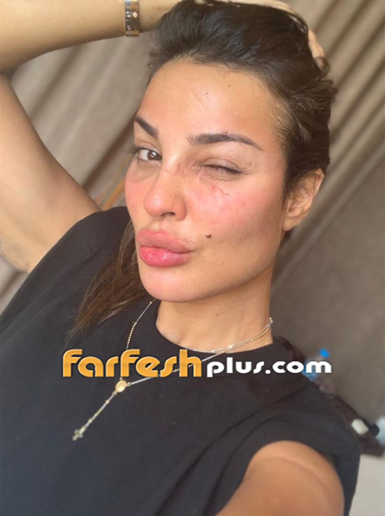 نادين نسيب نجيم تستعرض ندوبها بدون فلتر.. وهذا موعد ظهورها على التلفاز صورة رقم 4