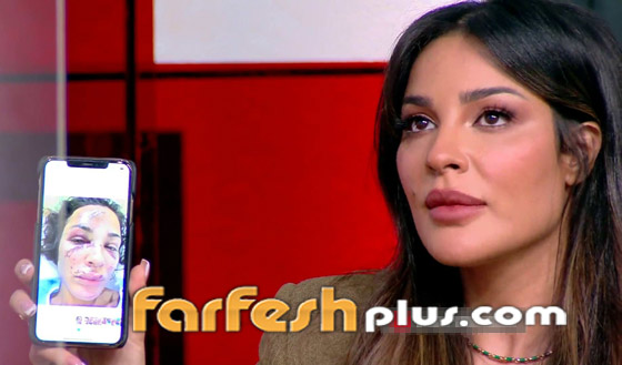 نادين نسيب نجيم تكشف عن صور وجهها المشوه لأول مرة بعد انفجار بيروت صورة رقم 4