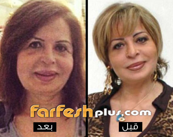 صور صادمة وفيديو: فنانة مصرية تصاب بشلل بعد عملية تجميل صورة رقم 6