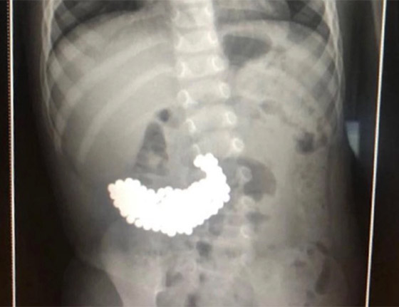فريق طبي يستخراج 200 كرة مغناطيسية من داخل معدة رضيع! صور صورة رقم 5