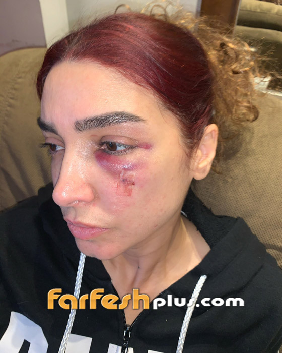 إصابة مروعة لروجينا أثناء تصوير مسلسل (بنت السلطان)! وأول تعليق لها صورة رقم 5