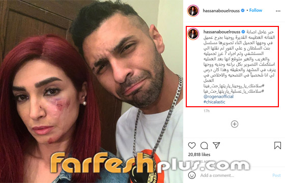 إصابة مروعة لروجينا أثناء تصوير مسلسل (بنت السلطان)! وأول تعليق لها صورة رقم 1
