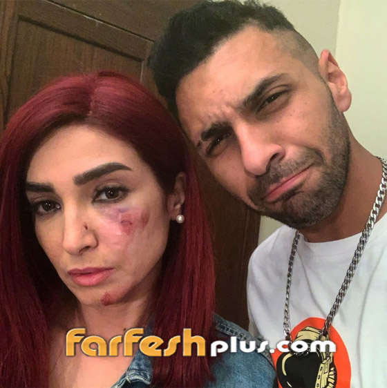 إصابة مروعة لروجينا أثناء تصوير مسلسل (بنت السلطان)! وأول تعليق لها صورة رقم 4