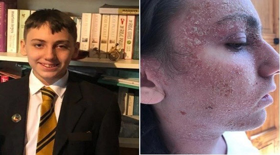 يطلب وضعه في غيبوبة ليتخلص من آلام الأكزيما المبرحة صورة رقم 1