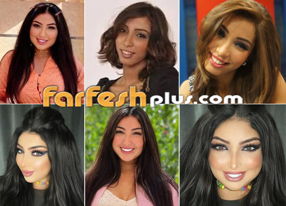 صور نجمات قبل وبعد عمليات التجميل والتغيير صادم: سوسن هارون، دنيا بطمة و صورة رقم 4