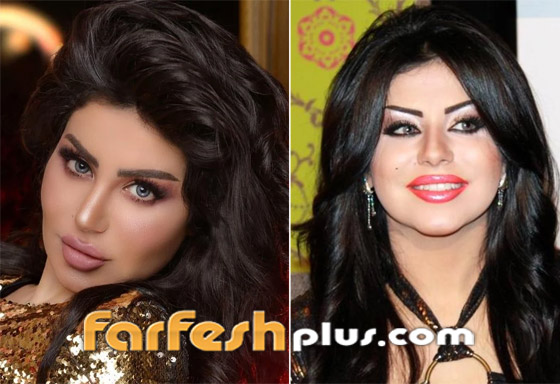 صور نجمات قبل وبعد عمليات التجميل والتغيير صادم: سوسن هارون، دنيا بطمة و صورة رقم 7