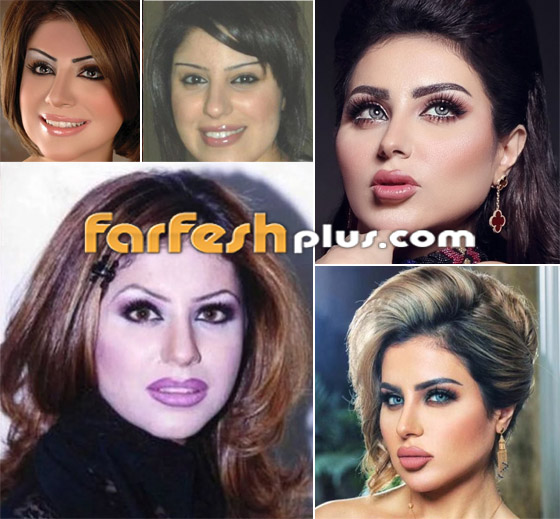 صور نجمات قبل وبعد عمليات التجميل والتغيير صادم: سوسن هارون، دنيا بطمة و صورة رقم 8