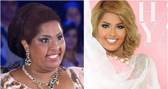 نجمات الخليج قبل وبعد التجميل  صور صادمه : صورة رقم 3