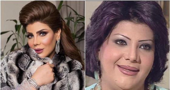 نجمات الخليج قبل وبعد التجميل  صور صادمه : صورة رقم 17