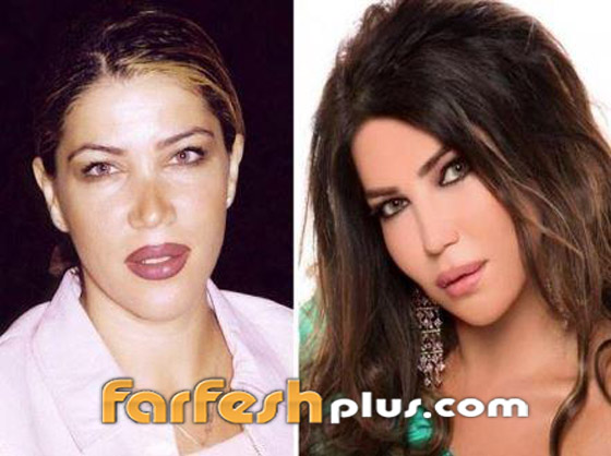 صور قبل وبعد: 15 فنانة اعترفن بإجراء عمليات تجميل غيرت شكلهن كليا صورة رقم 12