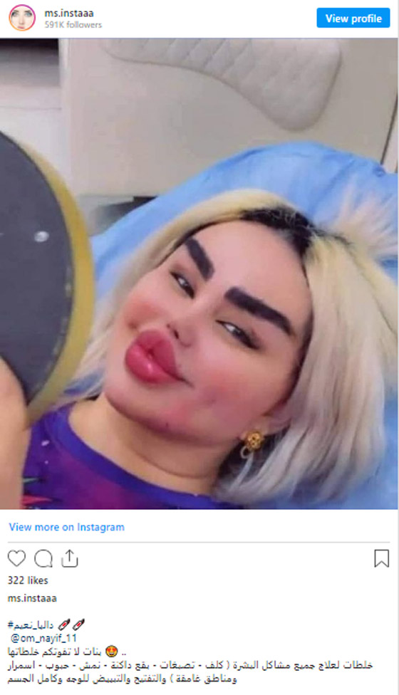 صور صادمة: داليا نعيم بعد عملية تجميلية، شفاهها مخيفة والجمهور: فيلم الرعب!! صورة رقم 2