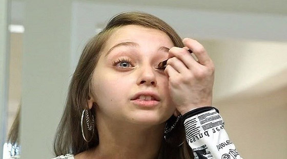 عشرينية تبدو وكأنها بعمر طفلة في الثامنة بسبب حالة نادرة صورة رقم 1
