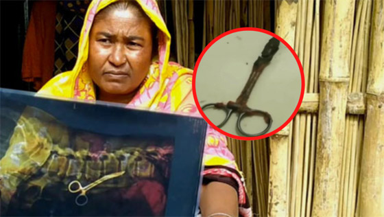 تعيش مع مقص جراحي في بطنها لمدة 20 عاماً صورة رقم 8