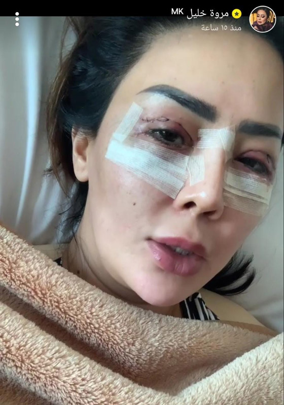 قائمة بالمشاهير الذين خضعوا لعمليات تجميل في 2022 صورة رقم 5