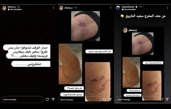 صور صادمة: زوجة سعيد المارق تكشف عنفه وقسوته معها.. جروح خطرة وعض مؤلم! صورة رقم 2