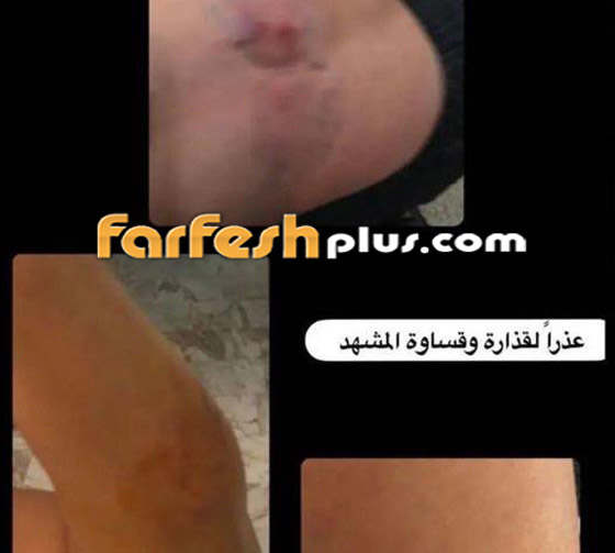 صور صادمة: طليقة سعيد الماروق تفضحه: أكل لحمي بأسنانه وضربني بقسوة وأسال دمي! صورة رقم 6