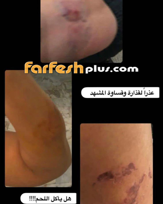 صور صادمة: طليقة سعيد الماروق تفضحه: أكل لحمي بأسنانه وضربني بقسوة وأسال دمي! صورة رقم 2