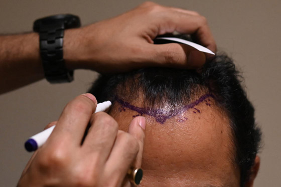 يجريها هواة على يوتيوب! عملية زراعة الشعر تتسبب بمقتل رجل هندي صورة رقم 4