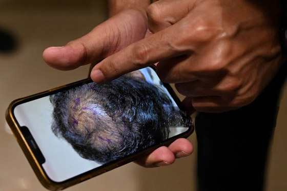 يجريها هواة على يوتيوب! عملية زراعة الشعر تتسبب بمقتل رجل هندي صورة رقم 3
