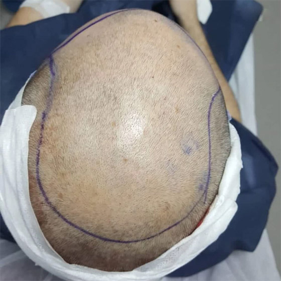 يجريها هواة على يوتيوب! عملية زراعة الشعر تتسبب بمقتل رجل هندي صورة رقم 1