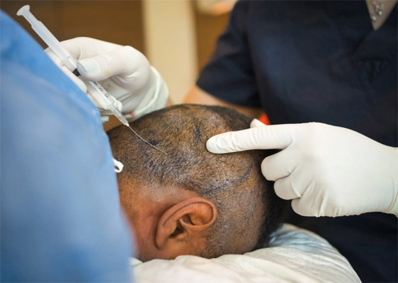 يجريها هواة على يوتيوب! عملية زراعة الشعر تتسبب بمقتل رجل هندي صورة رقم 2