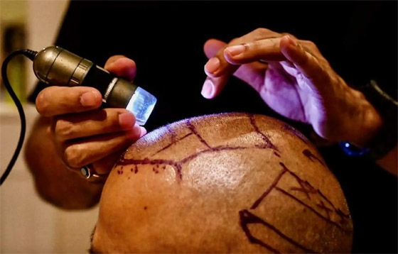 يجريها هواة على يوتيوب! عملية زراعة الشعر تتسبب بمقتل رجل هندي صورة رقم 5
