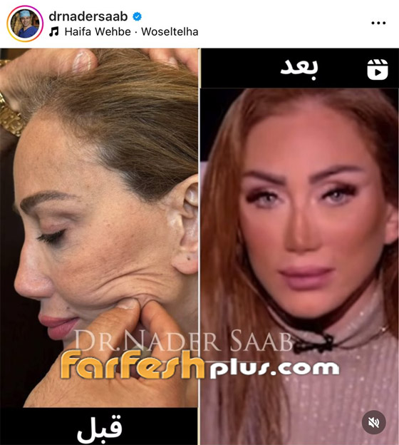 ريهام سعيد تتهم طبيب تجميل لبناني بتشويه وجهها، ونادر صعب يرد مهددا بدعوى صورة رقم 5