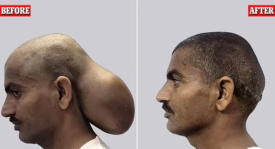 هندي عاش برأسين لمدة 15 عاما.. ما قصته؟ صورة رقم 1