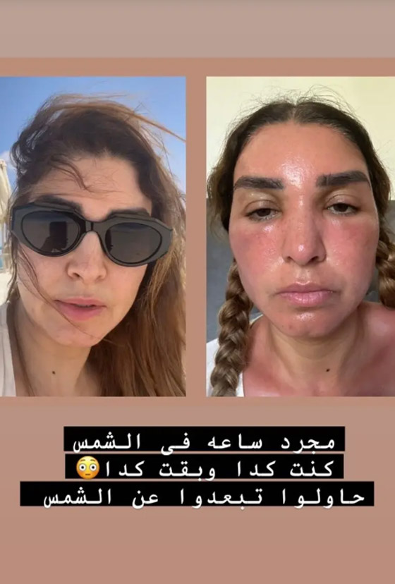 صور صادمة للفنانة روجينا: تضخم بالوجه وحروق! ونصائح لحماية البشرة من حروق الشمس! صورة رقم 1