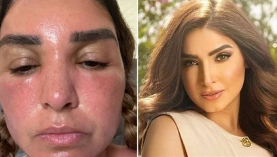 صور صادمة للفنانة روجينا: تضخم بالوجه وحروق! ونصائح لحماية البشرة من حروق الشمس! صورة رقم 2