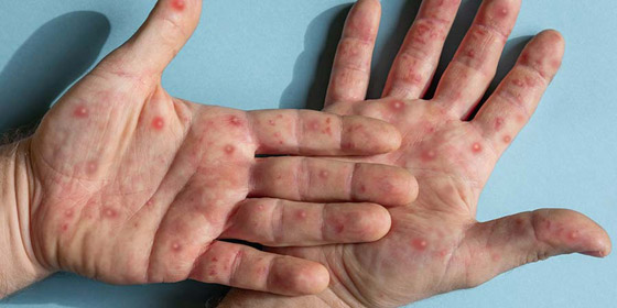 يثير مخاوف عالمية.. نيويورك تؤكد أول إصابة بجدري القردة صورة رقم 4
