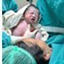 اليمن: طفل يحمل شقيقه التوأم في احشائه!!