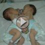 قلب واحد ينبض في جسدي مولودتين فلسطينتين شقيقتين 