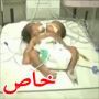 ولادة نادرة في الهند لتوأم ملتصق بجسد واحد ورأسين 