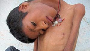 صور طفل غير قابل للشنق.. يحني عنقه بزاوية 30 درجة