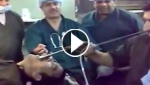 شاهد كيف اخرج  اطباء عراقيون مفتاحا من بلعوم رجل.. لحظة اثر لحظة