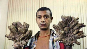 بعد 16 عملية جراحية.. الرجل الشجرة يعود الى طبيعته! صور