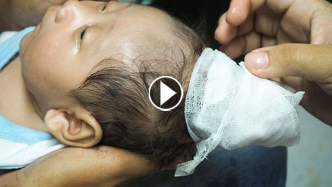 بالفيديو والصور.. حالة نادرة لولادة طفل مع قرن في رأسه 